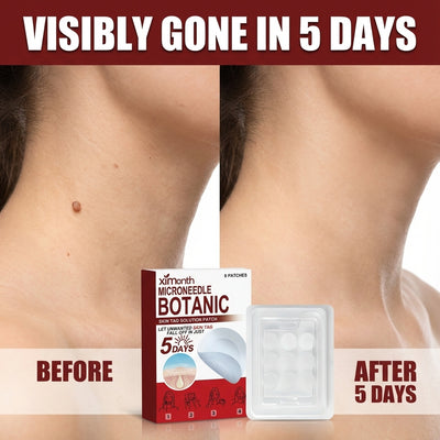 Microneedle Skin Tag Removal Patch